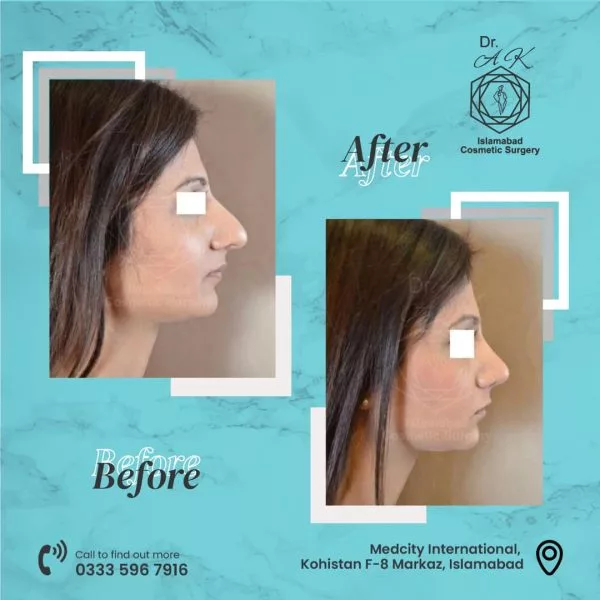 When Is the Best Time to Consider Rhinoplasty Cost in Islamabad?