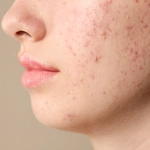 Pimples Treatment in Dubai for Acne-Prone Skin