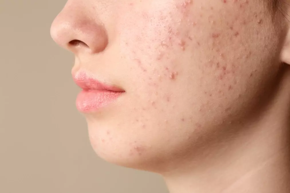 Pimples Treatment in Dubai for Acne-Prone Skin