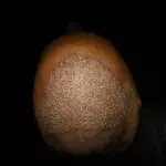Hair Transplant in Al Ain for Mild to Moderate Hair Loss