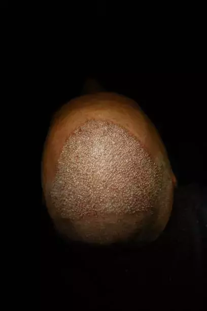 Hair Transplant in Al Ain for Mild to Moderate Hair Loss