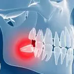 Teeth Exposure for Braces: Helping Teens Smile Confidently