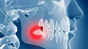Teeth Exposure for Braces: Helping Teens Smile Confidently