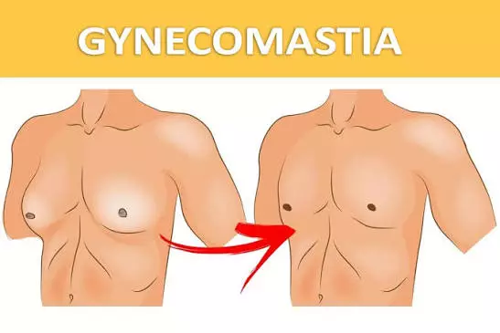 Understanding What Influences Gynecomastia Surgery Pricing