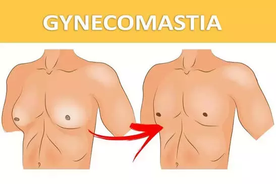 When men search for gynecomastia surgery cost in India, one of the first things they notice is how wide the price range is. One clinic quotes Rs. 30,000. Another quotes Rs. 2,00,000. Both call it gynecomastia surgery. So what is actually different, and wh