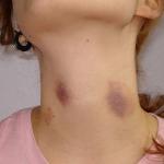 How To Get Rid Of Love Bites
