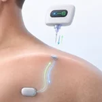 Implantable USB Port for Humans: New Bioelectronic Outlet Powers Medical Devices Under Skin