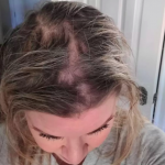 Olaplex Products Cause Hair Loss, Lawsuit Claims