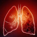 Kemri: TB Vaccine Trials Promising