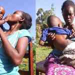 When the Spine Fails To Develop Fully: Exploring Spina Bifida