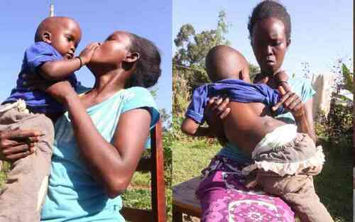 When the Spine Fails To Develop Fully: Exploring Spina Bifida