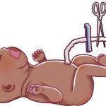 Clamping The Umbilical Cord Straight After Birth Is Bad For A Baby's Health
