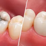 Dental Crown vs. Filling: Which Treatment Do You Need?