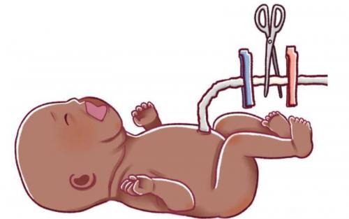 Clamping The Umbilical Cord Straight After Birth Is Bad For A Baby's Health