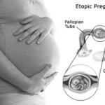 Ectopic Pregnancy Scary, But You Can Still Have Children