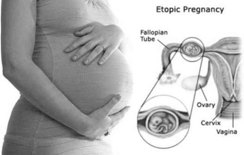 Ectopic Pregnancy Scary, But You Can Still Have Children