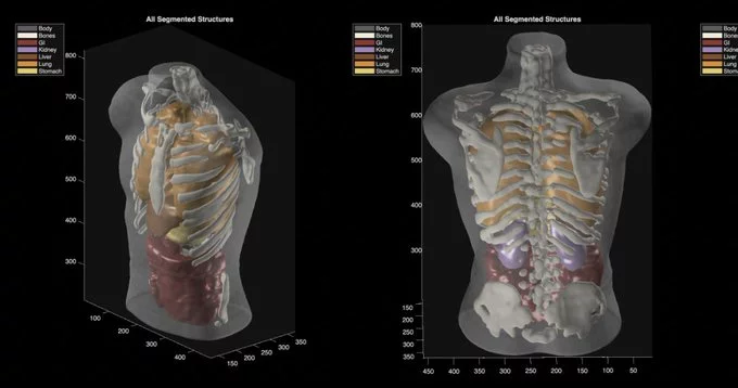 From Cat Images to Full-Body Scans: The Rise of Midjourney Medical in Healthcare AI