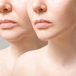 Rethinking Topical Skincare Myths and Embracing Deep Dermal Remodeling