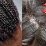 Ditch Pesky Dandruff Permanently!
