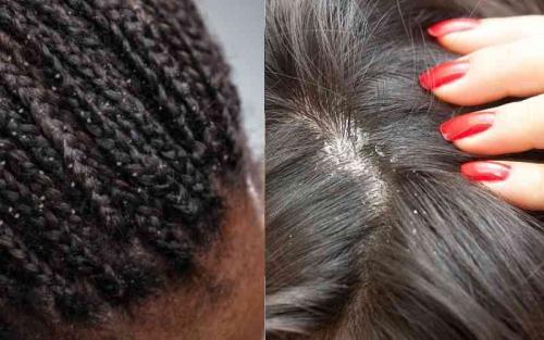 Ditch Pesky Dandruff Permanently!
