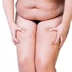 What to Know Before Starting Lipedema Treatment for Symptom Relief