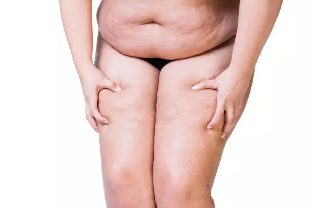 What to Know Before Starting Lipedema Treatment for Symptom Relief
