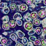 39-year-old unvaccinated woman becomes 6th measles death in Pennsylvania