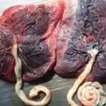 Dried placenta may help men regain erections faster after prostate surgery – Study