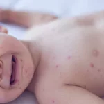 Pennsylvania issues alert on congenital measles—something US hasn't seen for decades
