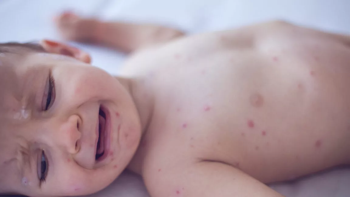 Pennsylvania issues alert on congenital measles—something US hasn't seen for decades