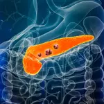 AI detects “invisible” signs of pancreatic cancer years before diagnosis