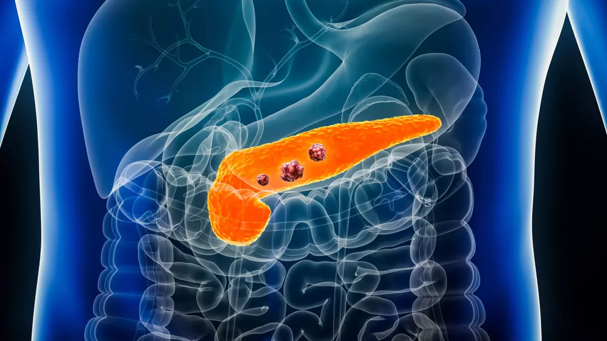 AI detects “invisible” signs of pancreatic cancer years before diagnosis