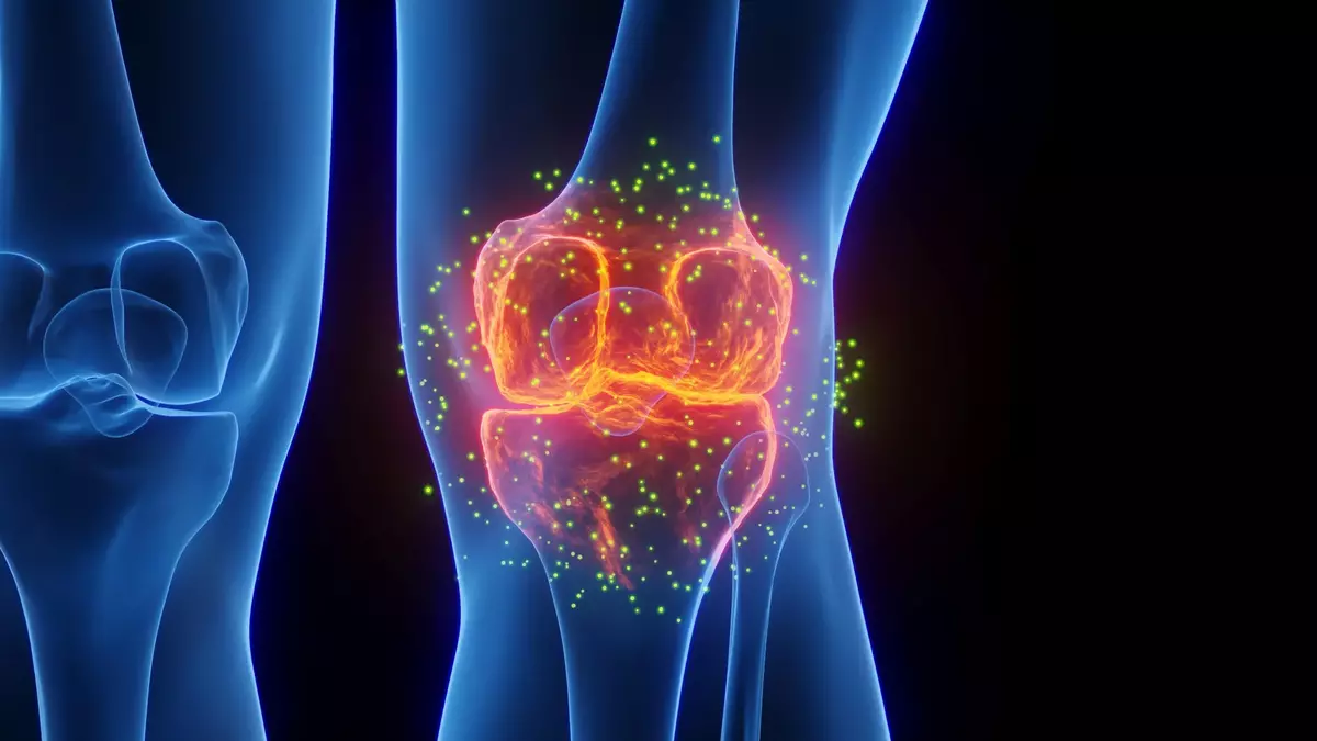 FDA-approved epilepsy drug may help reverse osteoarthritis damage