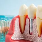 Dental implants can hijack your immune system, scientists discover