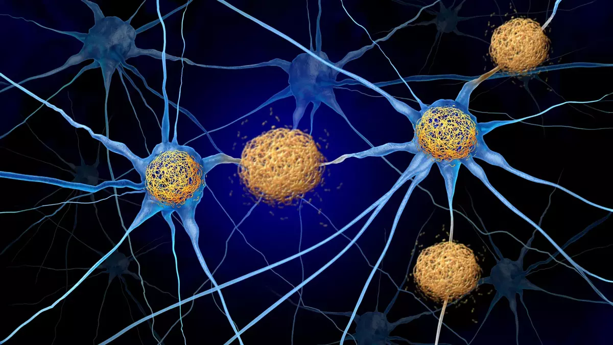 Scientists may have overlooked a hidden Alzheimer's culprit for decades