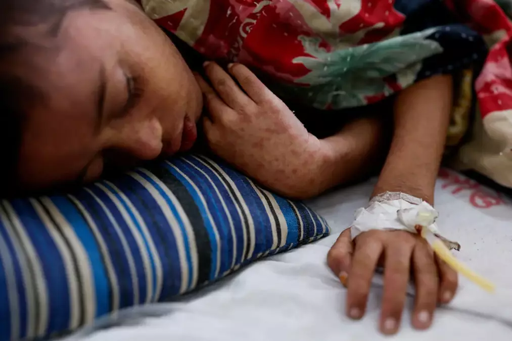 Bangladesh is battling measles. It's a 'real warning' to other nations