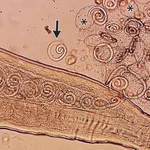 Worms mate in man's eyes, get plucked out right before larvae burst out