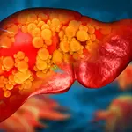 A plastic once thought harmless may be fueling fatty liver disease