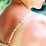 Moderna mRNA vaccine almost halves the risk of skin cancer returning