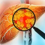 Fatty liver disease is actually five different conditions, scientists discover
