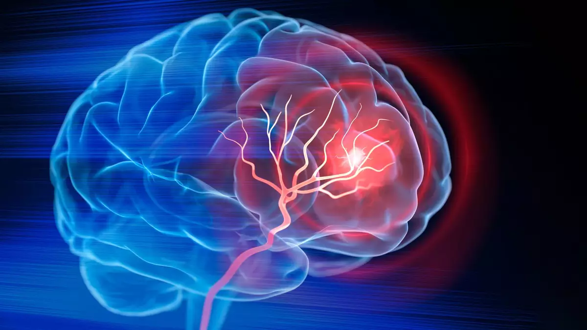 Alzheimer’s risk gene APOE4 may have a reversible weakness