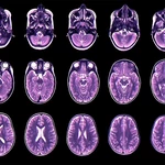 Teen depression and anxiety predicted by childhood brain development