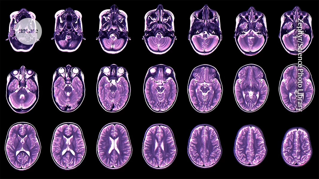 Teen depression and anxiety predicted by childhood brain development