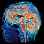 Rare study reveals a striking divide inside an Alzheimer’s patient’s brain