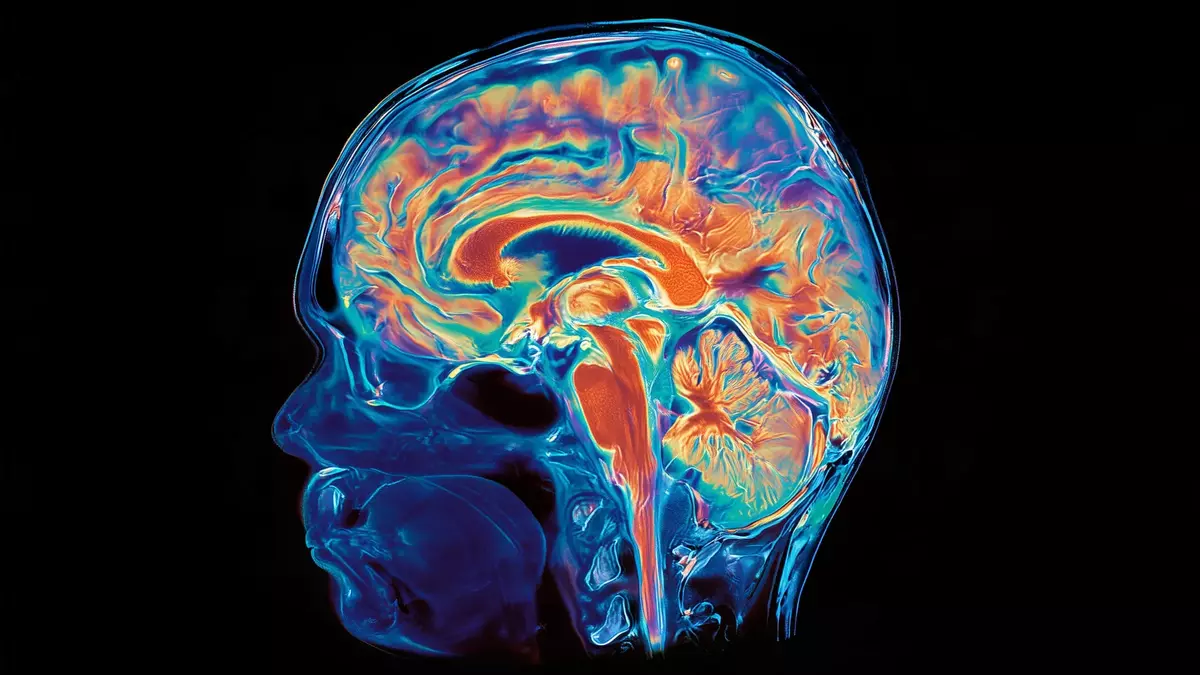 Rare study reveals a striking divide inside an Alzheimer’s patient’s brain