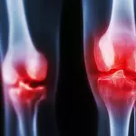 Why painful arthritis can return stronger after cancer treatment