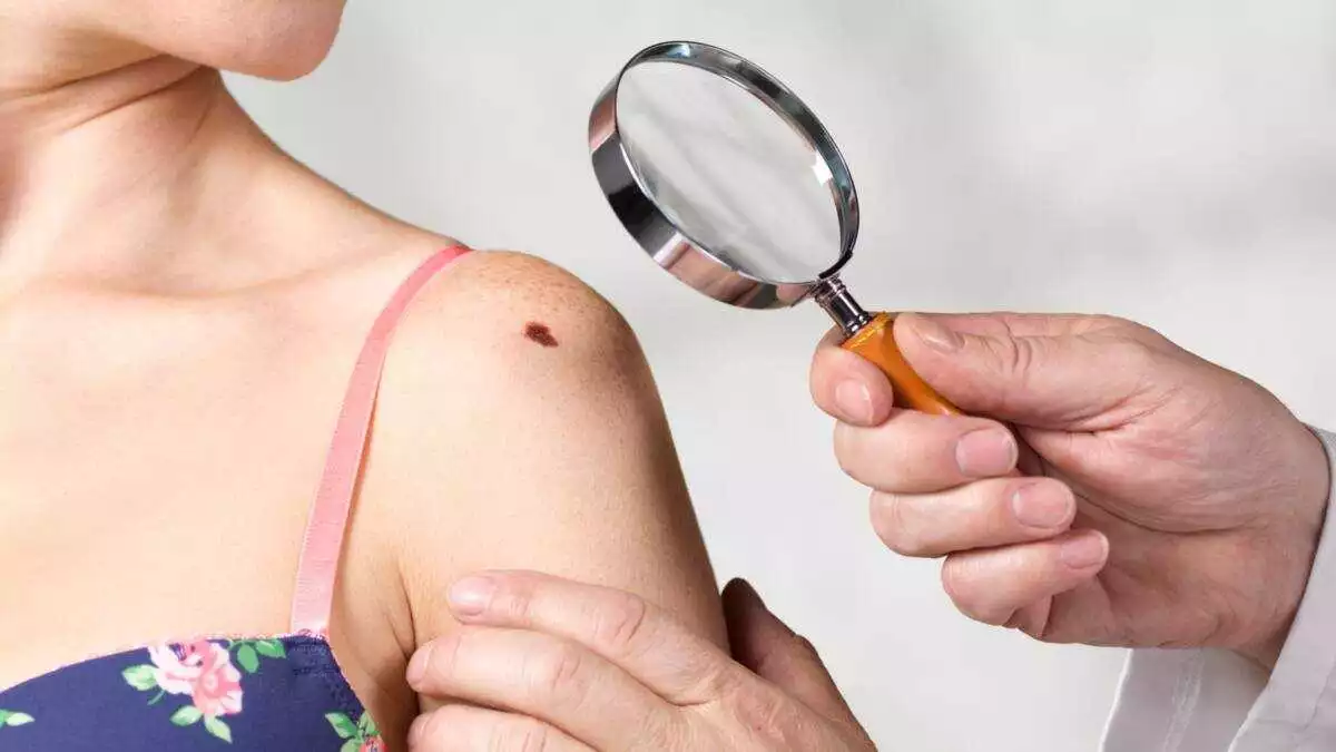 Types of birthmarks and their meanings based on shapes and location